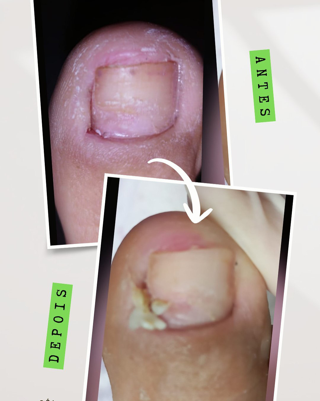 Antes e depois de tratamento de unha encravada realizado na AC Estética e Podologia em Avaré.