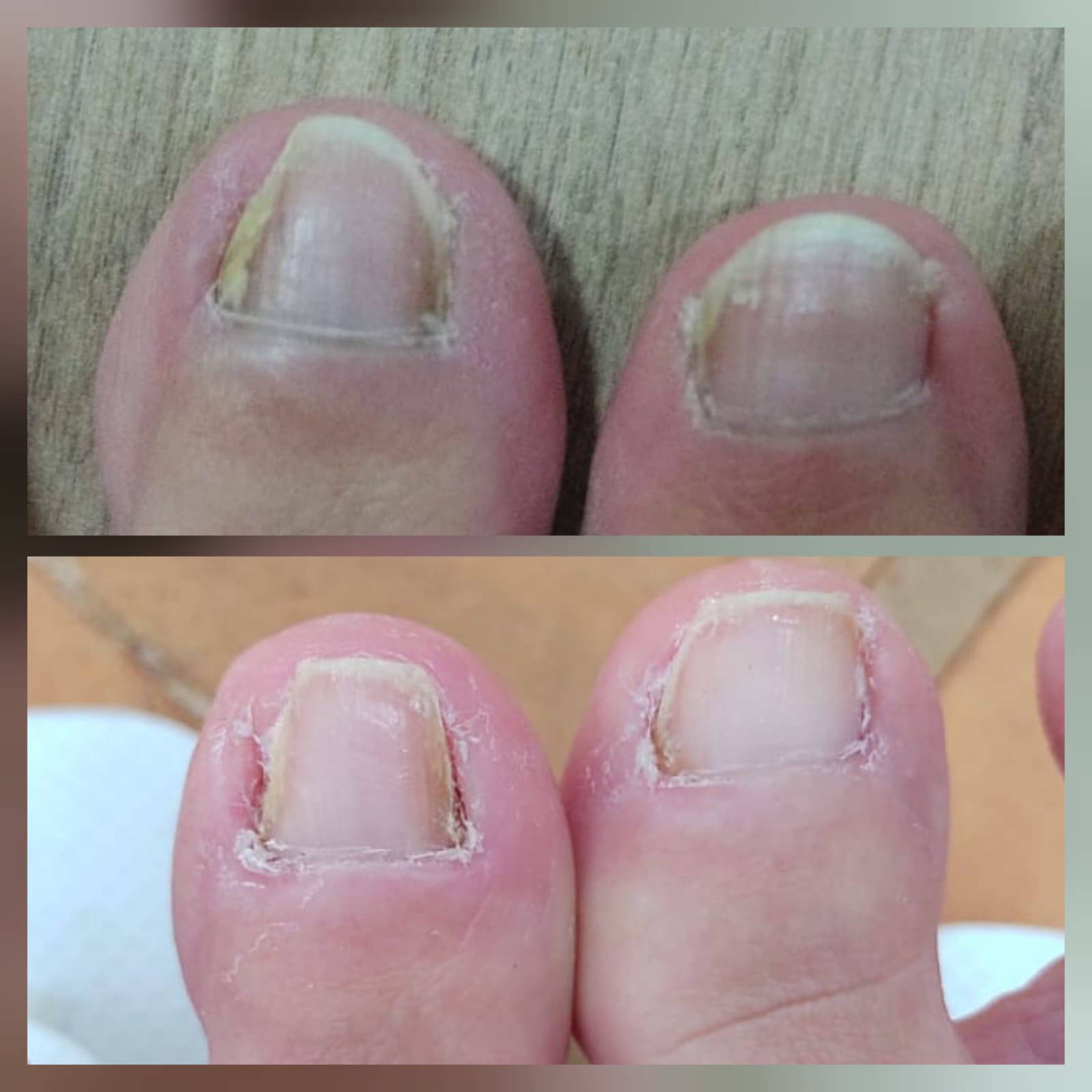 Antes e depois de aplicação de órtese corretiva na AC Estética e Podologia em Avaré.